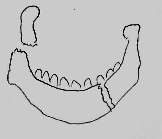 MANDIBLE: The standard views for the mandible: - AP - Both obliques - These can be replaced by an orthopantomograph (OPG) when available, the tube moving around the jaw while exposing.