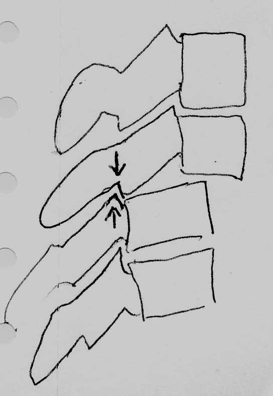 fracture/dislocation, hangman s fracture (arch of C2), fractures of the ring of C1, facet joint