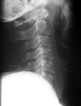 multiple levels Normal facet Abnormal widening Dislocated facet In this patient following