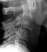This is the appearance of a Hangman s fracture, a fracture through the posterior arch of C2.