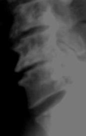 Vertebrae may lose height along with the disc spaces and when this happens bony spurs are always present. The bony cortex is intact and the appearances are not usually significant.
