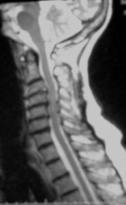 Infection may also present with loss of disc space before bone changes become visible on X-ray. This patient had degenerative disc disease.