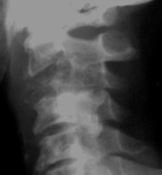 Primary neoplasms are rare in the cervical spine but it is not infrequently involved in metastatic disease or multiple myeloma.