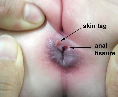 small blue swelling, can be painful, can