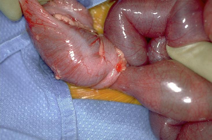 Intussusception 1 in 500 9-12 months Scream, pull legs up, go pale Distension + bile vomit + mass Significant fluid losses XR