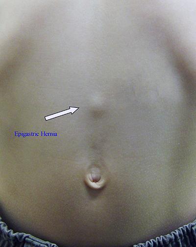 Epigastric Hernia Common May be asymptomatic Ache/discomfort with