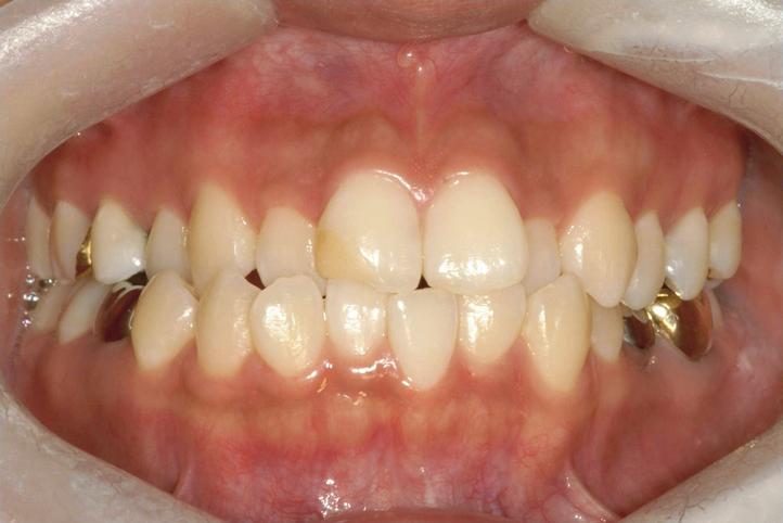 1) The treatment plan was to level and align the teeth via orthodontic treatment before surgery.