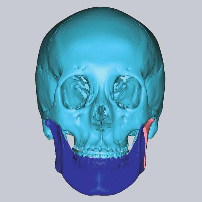 Unilateral IVRO Fig. 4. Final surgical simulation image, with only left mandibular ramus osteotomy.