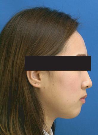 Jae-Won Lee et al: Unilateral intraoral vertical ramus osteotomy based on preoperative three-dimensional simulation surgery in a patient with facial asymmetry. J Korean Assoc Oral Fig. 5.