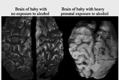 Alcohol Effects first recognized in 1968 Fetal Alcohol Syndrome defined in 1973 Fetal Alcohol