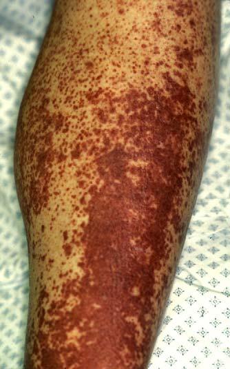 410 J.K. McKenna, K.M. Leiferman / Immunol Allergy Clin N Am 24 (2004) 399 423 Fig. 4. Leukocytoclastic vasculitis involving the lower extremity, demonstrating classic palpable purpura.
