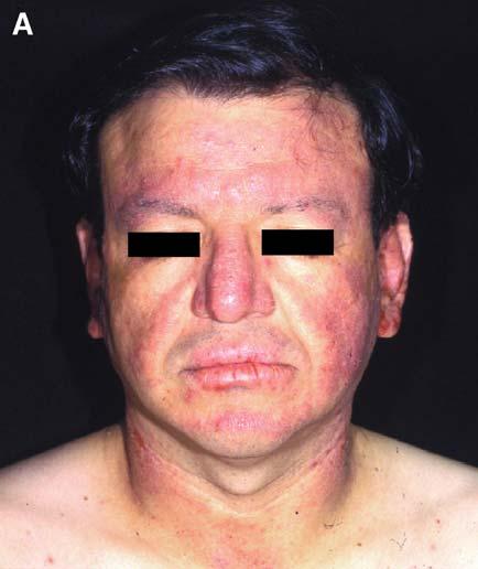 J.K. McKenna, K.M. Leiferman / Immunol Allergy Clin N Am 24 (2004) 399 423 413 Fig. 5. Chronic phototoxic drug reaction. (A) Lichenified papules and plaques with excoriations.