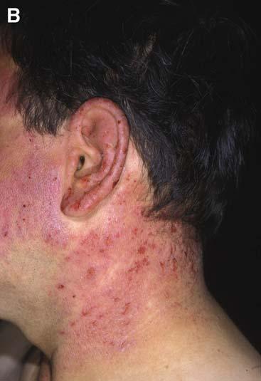 There is notable sparing of the postauricular skin and anterior neck, chin shadow. ous lupus erythematosus, which is an exquisitely photosensitive type.