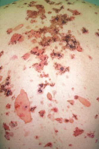 418 J.K. McKenna, K.M. Leiferman / Immunol Allergy Clin N Am 24 (2004) 399 423 resembles pemphigus foliaceus, with superficial flaccid blisters and crusted erosions but no mucosal involvement.