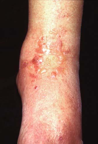 J.K. McKenna, K.M. Leiferman / Immunol Allergy Clin N Am 24 (2004) 399 423 419 Fig. 8. Drug-induced bullous pemphigoid from furosemide. Tense vesicles and bullae are shown on the dorsum of the foot.