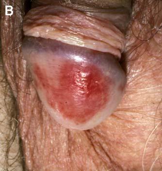 (Photograph courtesy of Leonard J. Swinyer, MD.) ferential diagnosis includes an insect bite. Diagnostic difficulty arises when there is an atypical presentation of a fixed drug eruption.