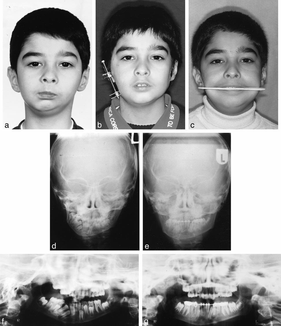 TREATMENT OF MANDIBULAR ASYMMETRY 169 FIGURE 3. Case 3. (A) Initial facial photograph. (B) Frontal view after 22 mm of mandibular distraction. (C) Facial photograph 2 years following treatment.