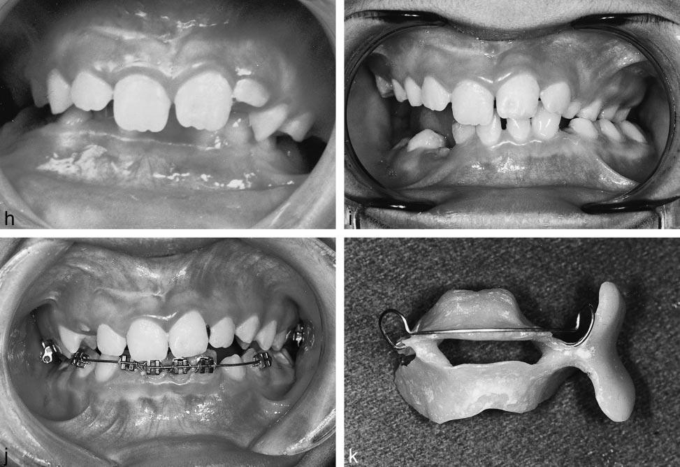 170 TEHRANCHI, BEHNIA FIGURE 3. Continued. (H) Dental occlusion prior to treatment. (I) Dental occlusion after mandibular distraction. (J) Dental occlusion 2 years after treatment.