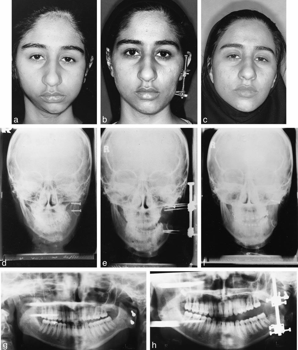 TREATMENT OF MANDIBULAR ASYMMETRY 171 FIGURE 4. Case 4. (A) Facial photograph prior to treatment. (B) Facial photograph after 21 mm of mandibular distraction. (C) Facial photograph 1.