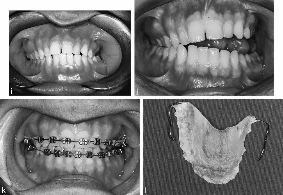 172 TEHRANCHI, BEHNIA FIGURE 4. Continued. (I) Dental occlusion before treatment. (J) Dental occlusion after distraction osteogenesis. (K) Dental occlusion 1.5 years after treatment.