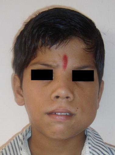 Case Report Giant Cell Lesion of the Jaw: A Case Report in a Child MK Gupta, *SG Naidu, *VJ Maheshwari Department of Oral & Maxillofacial Surgery, *Oral Medicine & Radiology, People s Dental Academy,