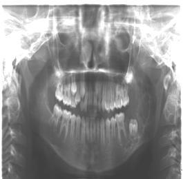Teeth # 37 and 38 were clinically missing. Tooth displacement and mobility were not evident in the same quadrant. The overlying mucosa appeared normal.