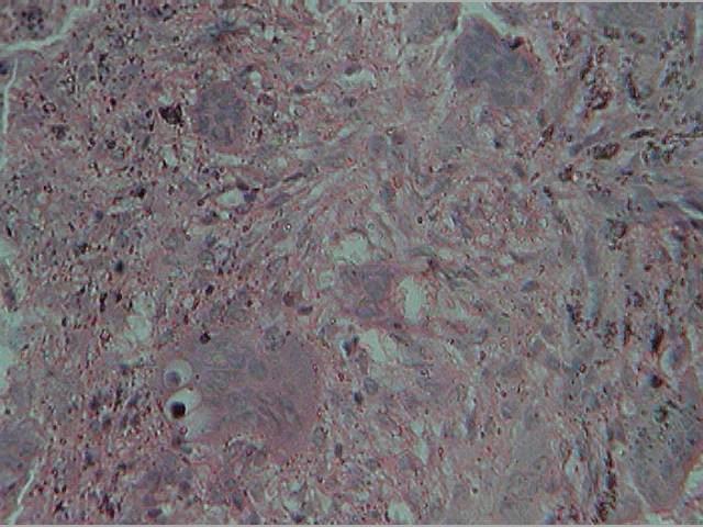 IV) showed a highly vascularized fibrous stroma with several multinucleated giant cells with 20-30 nuclei.