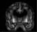 The fingerprint of AD Visual VBM 28 MTL atrophy: visual rating Widening of choroidal fissure Distance MTL to brainstem not relevant Loss of height of hippocampus/mtl Widening of temporal horn