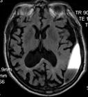 2% required neuroimaging Potentially reversible causes in