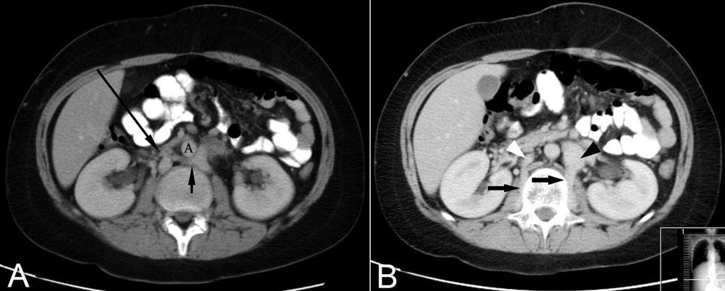 Figure 3: 11 year old male with dysgenesis of the inferior vena cava.