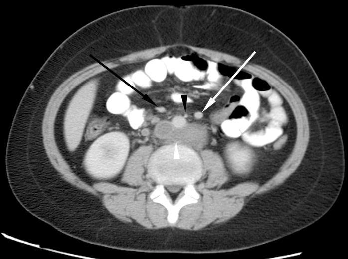 the aberrant IVC on the right (white arrow head) and left (black arrow head) after it has been joined by the renal veins.