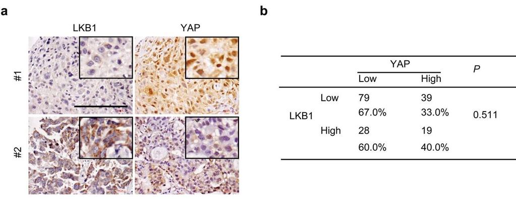 Supplementary Figures Supplementary Figure 1 Correlation between LKB1 and YAP expression in human lung cancer samples.