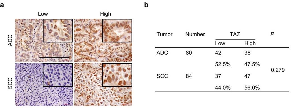 Supplementary Figure 2 TAZ expression in human lung ADC and SCC.
