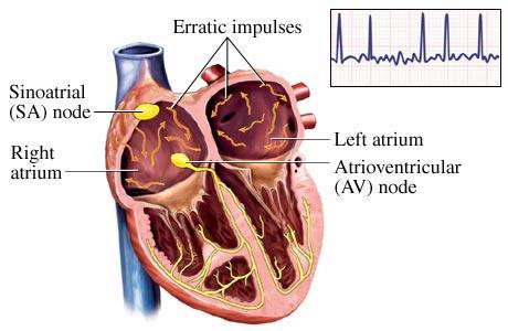 AF clinical background The most common arrhythmia Increased morbidity and mortality Irregular atrial