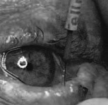 ! Cryosurgery, electrolysis, lasers have all been used and are painful and traumatic.! The Permanent Trichiasis Solution! Radiosurgical Follicular Ablation!