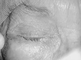 Numerous spot burns are placed with RFS bipolar forceps on the palpebral conj at the bottom of the