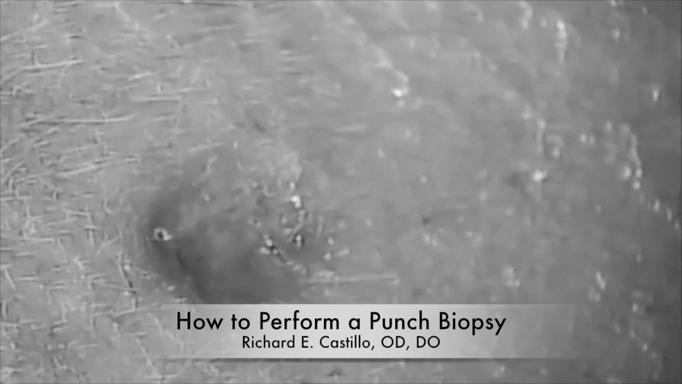 Punch Biopsy in Optometric Practice! Specimen is placed in formalin cup provided to you by the lab.