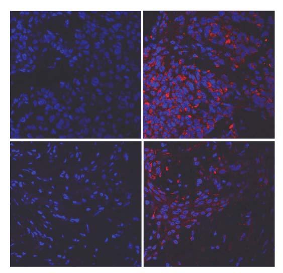 Control Anti-enteroviral protein Pt 2-5 (IVM1c) Nucleus Cytoplasmic CVA21 viral proteins Pt 3-6