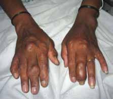 61.1% risk of gout. 15,16 Conversely, during an acute attack of gout, serum uric acid levels are normal in approximately a third of cases.