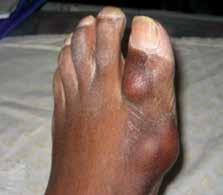 Clinical aspects of gout The acute attack and intercritical period After a variable period of months to years of asymptomatic hyperuricaemia, gout commonly presents as an acute attack of