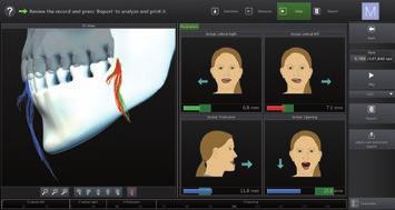 recorded threedimensional data for mandibular