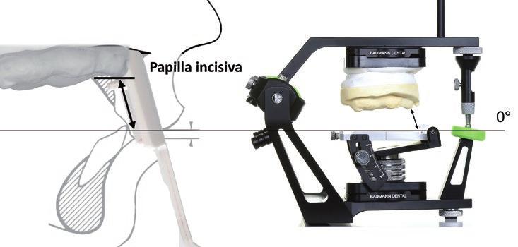 33, 34 In the case of an edentulous maxilla the height of the PlanePositioner is adjusted to the measured distance between incisive papilla and lip closure line.