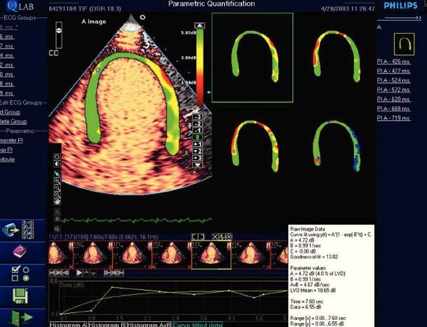 3. Parametric imaging, a novel method of automated quantification in which the myocardial blood flow is codified in colors all over