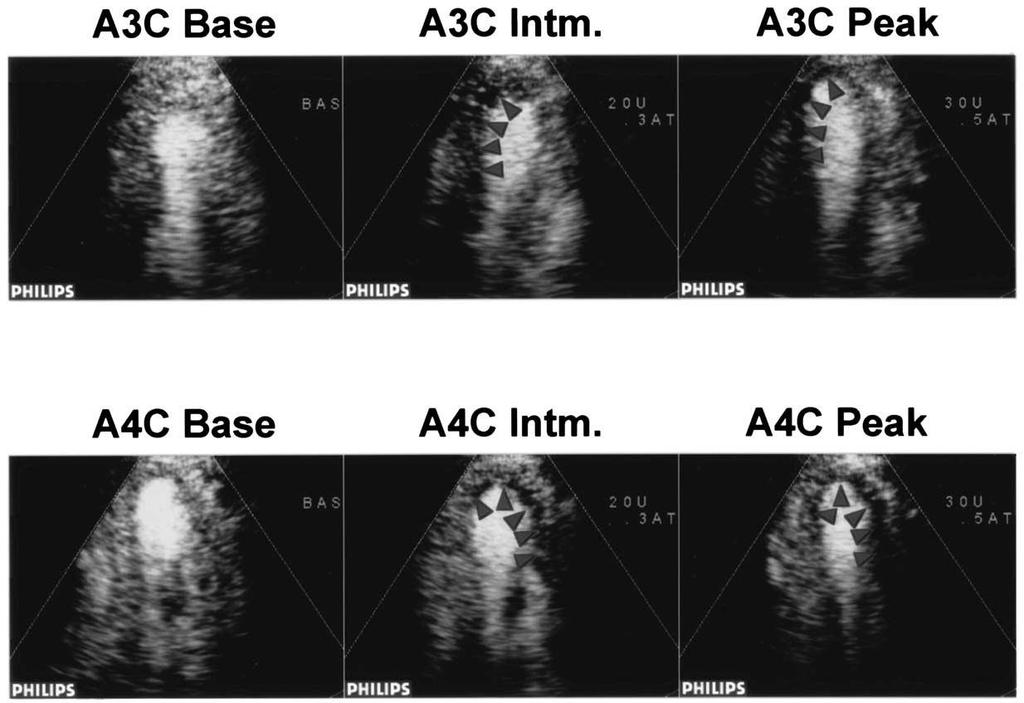 Comparative Accuracy of Real-Time MCE and WM Analysis During Dobutamine Stress Echo for the Diagnosis of CAD 170