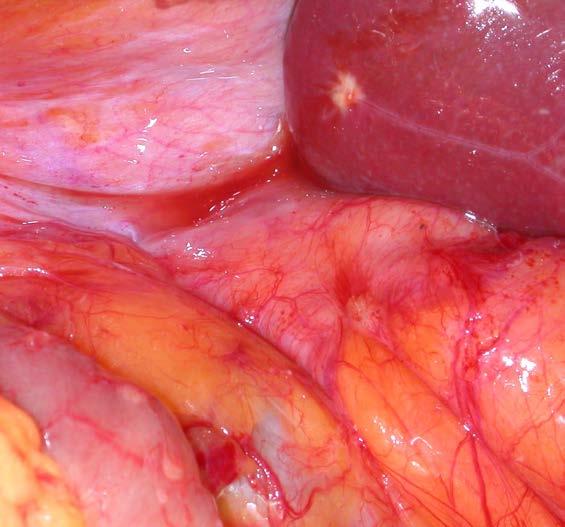 Peritoneal Disease Small
