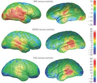 Abnormalities in brain development are related to 67 behavioural disorders FASD and Brain Plasticity 68