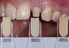 Since the shade of the restoration can be verified in advance and corrected where required, this product makes it easier to reproduce the tooth shade with greater reliability.