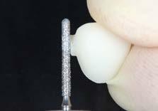 Prior to fitting or cementing, proximal areas are polished outside the mouth, for example with