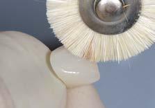 Careful polishing is important for the overall esthetic and functional appearance of the restoration.