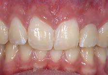 characterization of the shade (staining technique) is recommended for simple and reliable optimization of the esthetic